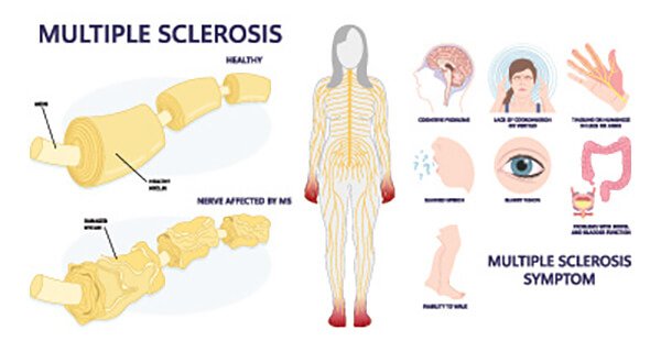 multiple sclerosis new