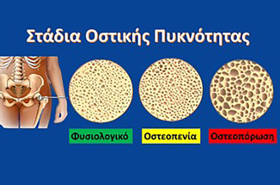 osteoporosi 1